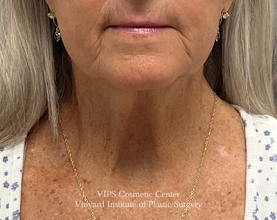 Deep CO2 Laser Skin Resurfacing Before & After Gallery - Patient 377514 - Image 2