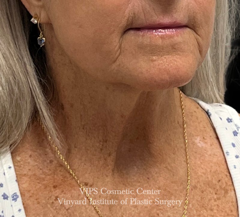 Deep CO2 Laser Skin Resurfacing Before & After Gallery - Patient 377514 - Image 4