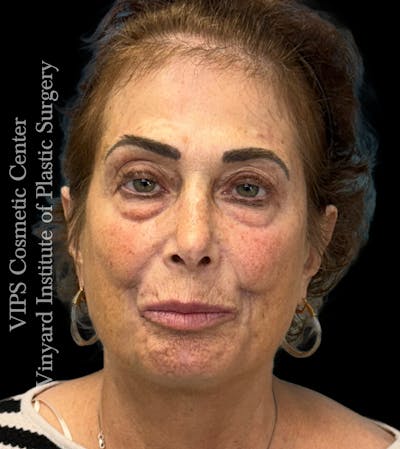 CoolPeel CO2 Laser Skin Resurfacing Before & After Gallery - Patient 296293 - Image 1