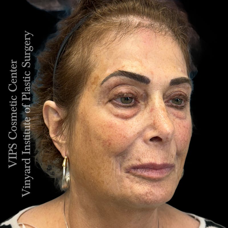 CoolPeel CO2 Laser Skin Resurfacing Before & After Gallery - Patient 296293 - Image 7