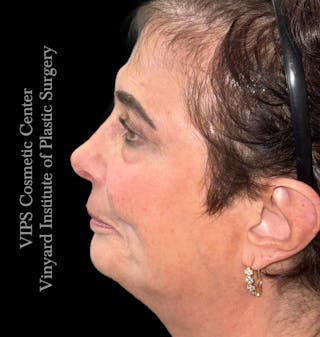 CoolPeel CO2 Laser Skin Resurfacing Before & After Gallery - Patient 296293 - Image 6