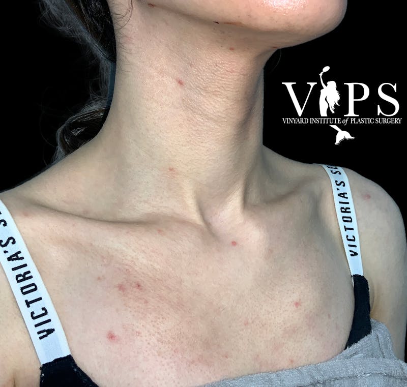 CoolPeel CO2 Laser Skin Resurfacing Before & After Gallery - Patient 225587 - Image 3