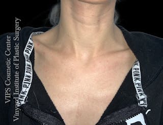 CoolPeel CO2 Laser Skin Resurfacing Before & After Gallery - Patient 225587 - Image 2