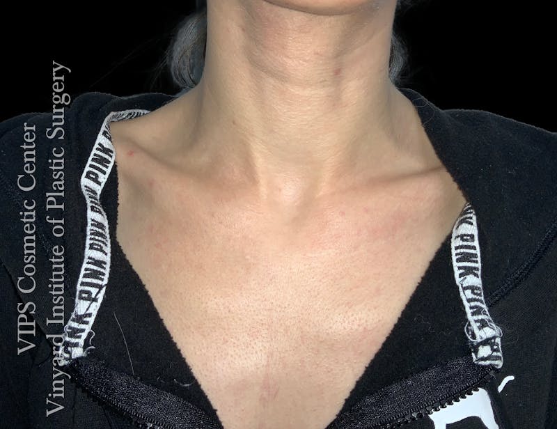 CoolPeel CO2 Laser Skin Resurfacing Before & After Gallery - Patient 225587 - Image 2