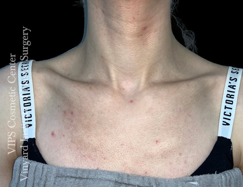 CoolPeel CO2 Laser Skin Resurfacing Before & After Gallery - Patient 225587 - Image 1