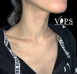 CoolPeel CO2 Laser Skin Resurfacing Before & After Gallery - Patient 225587 - Image 4