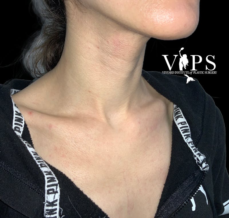 CoolPeel CO2 Laser Skin Resurfacing Before & After Gallery - Patient 225587 - Image 4