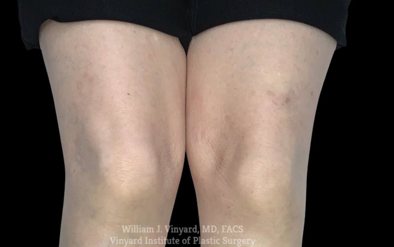 Laser Vein Removal Before & After Gallery - Patient 103502 - Image 2