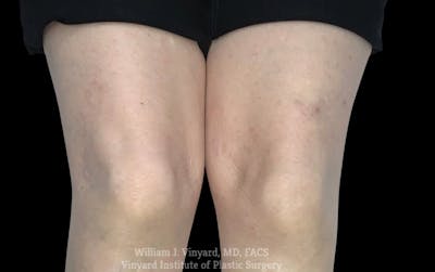 Laser Vein Removal Before & After Gallery - Patient 103502 - Image 2