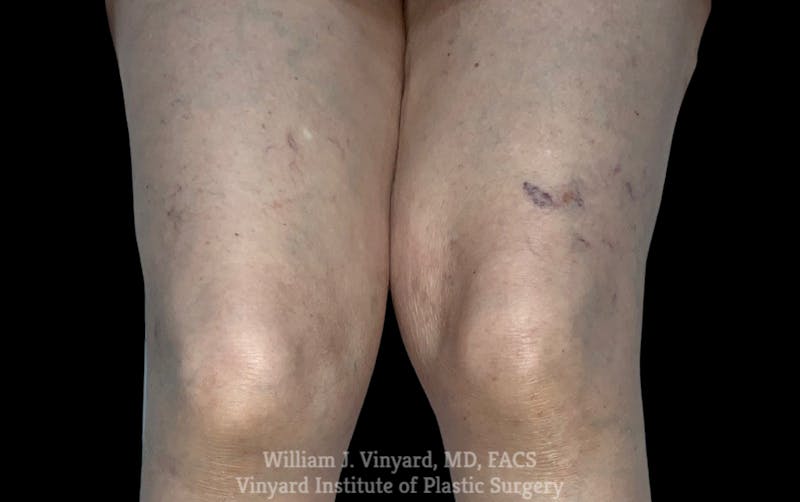 Laser Vein Removal Before & After Gallery - Patient 103502 - Image 1