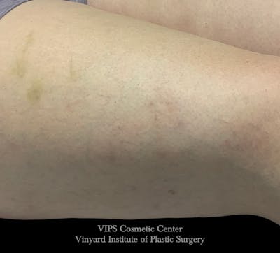 Laser Vein Removal Before & After Gallery - Patient 406138 - Image 2
