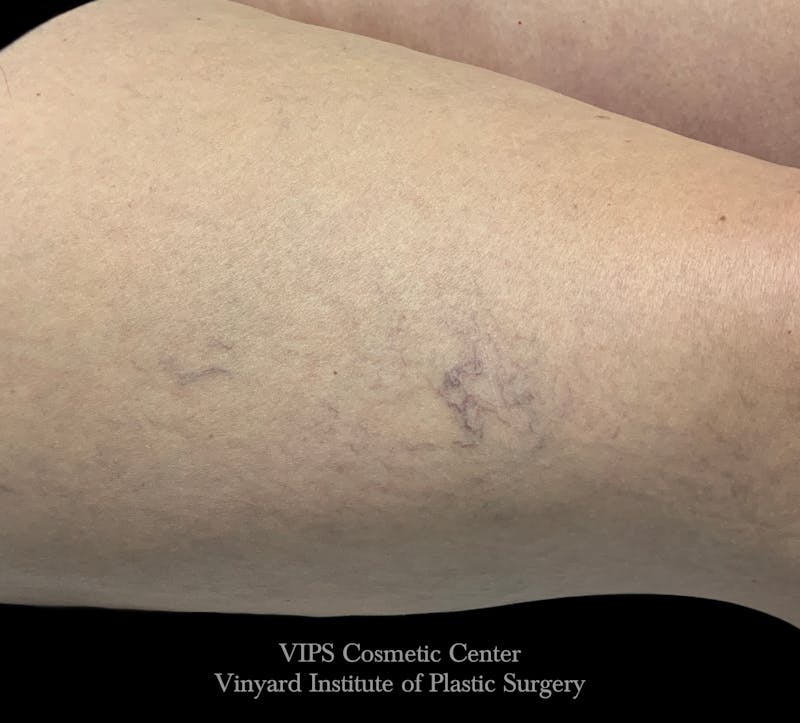 Laser Vein Removal Before & After Gallery - Patient 406138 - Image 1