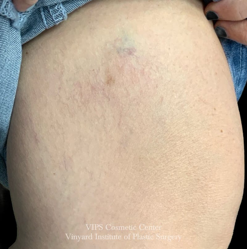 Laser Vein Removal Before & After Gallery - Patient 165211 - Image 2