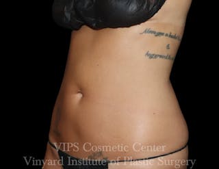 Coolsculpting ELITE Before & After Gallery - Patient 298113 - Image 2