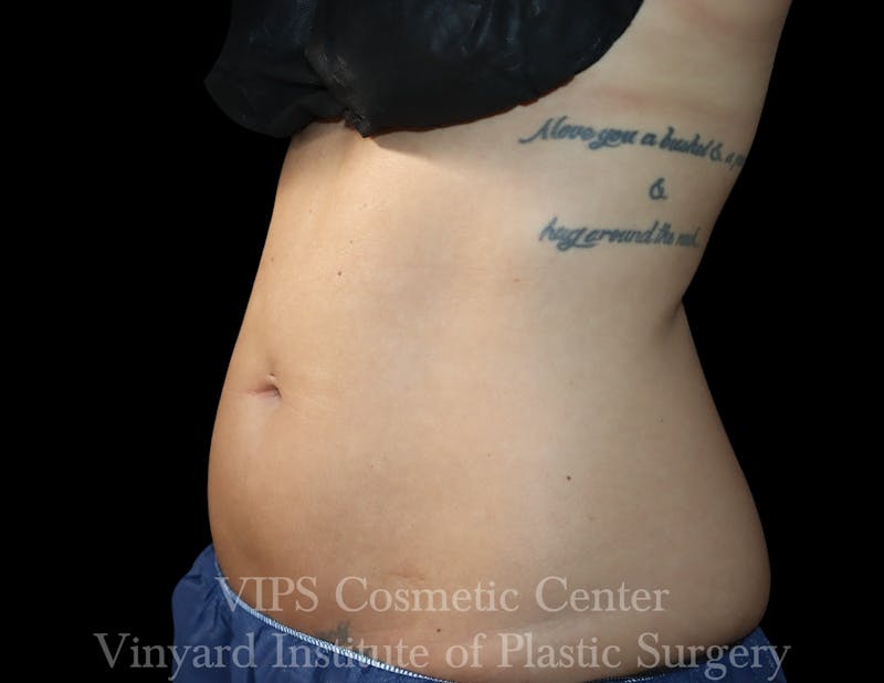 Coolsculpting ELITE Before & After Gallery - Patient 298113 - Image 1