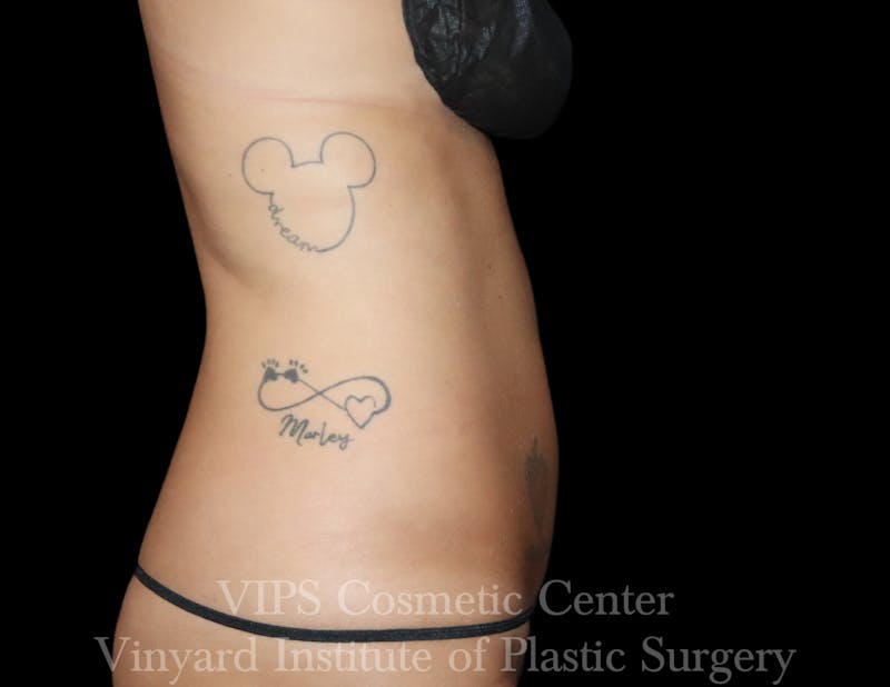 Coolsculpting ELITE Before & After Gallery - Patient 298113 - Image 4