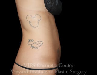 Coolsculpting ELITE Before & After Gallery - Patient 298113 - Image 4