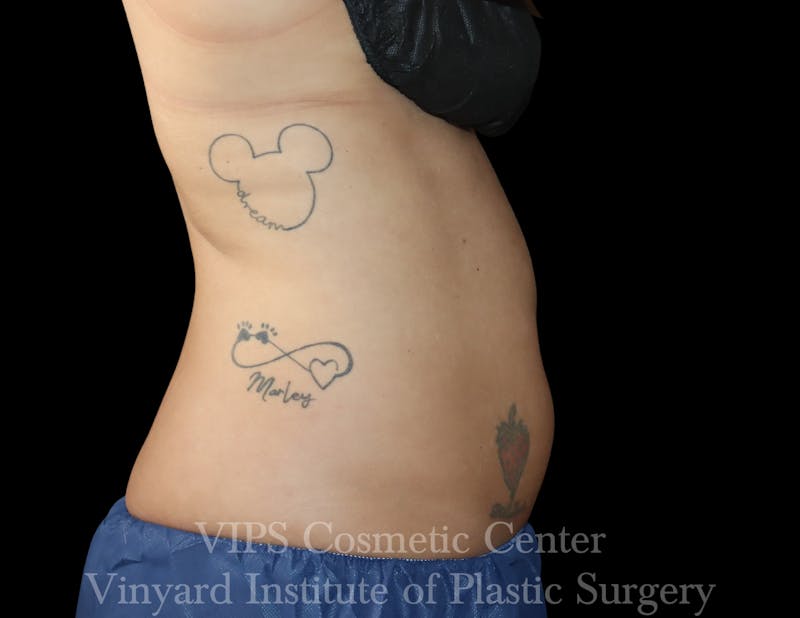 Coolsculpting ELITE Before & After Gallery - Patient 298113 - Image 3