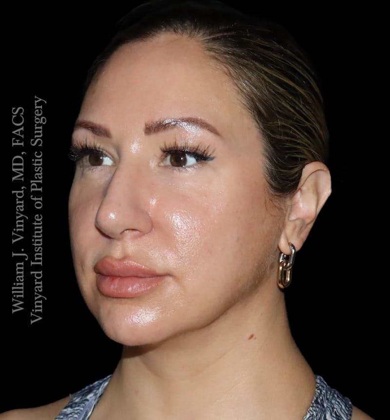 FACEtite Before & After Gallery - Patient 408106 - Image 6