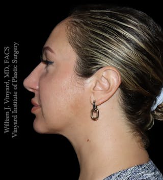 FACEtite Before & After Gallery - Patient 408106 - Image 8