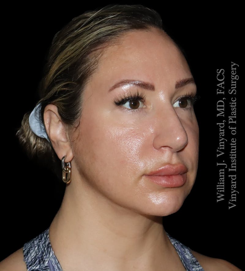 FACEtite Before & After Gallery - Patient 408106 - Image 2