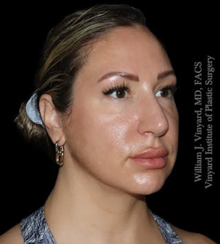 FACEtite Before & After Gallery - Patient 408106 - Image 2