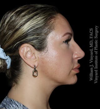 FACEtite Before & After Gallery - Patient 408106 - Image 4