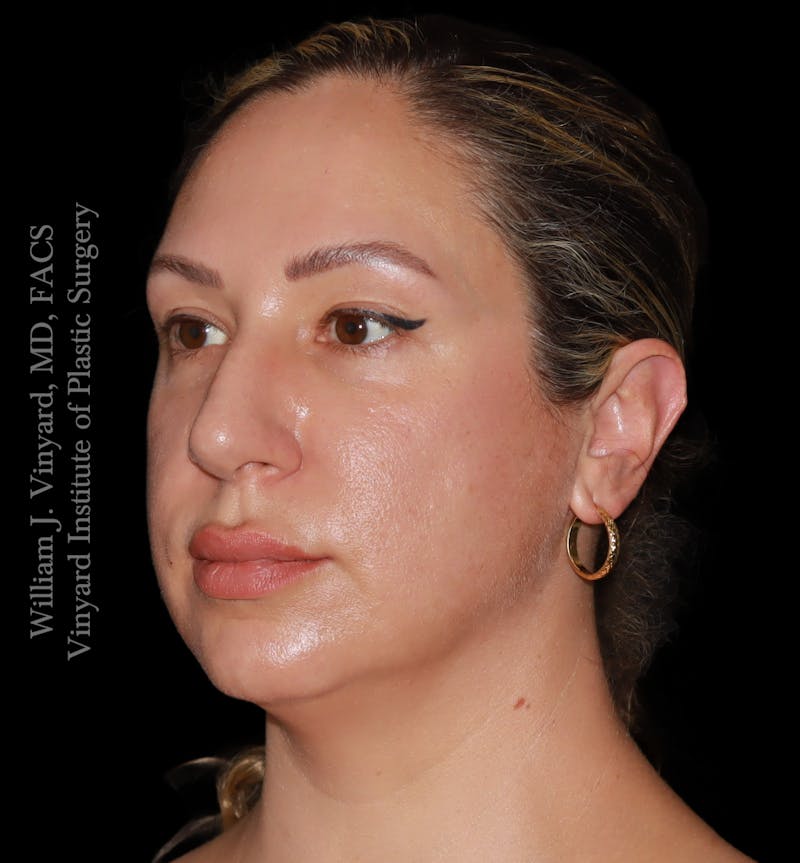 FACEtite Before & After Gallery - Patient 408106 - Image 5