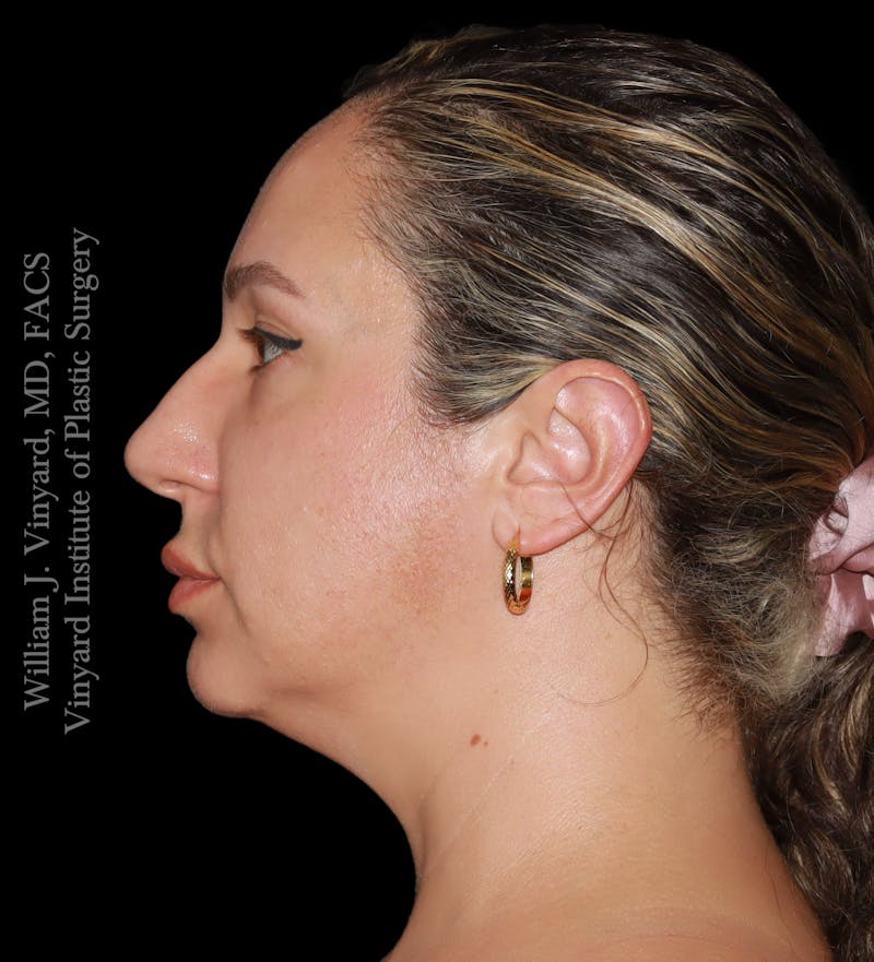 FACEtite Before & After Gallery - Patient 408106 - Image 7