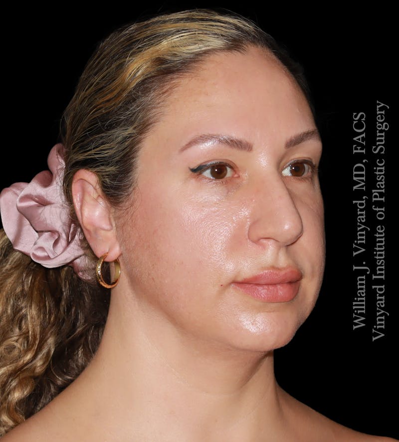 FACEtite Before & After Gallery - Patient 408106 - Image 1