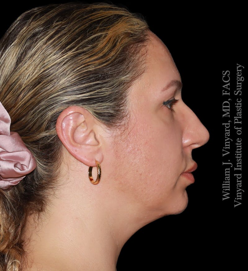 FACEtite Before & After Gallery - Patient 408106 - Image 3