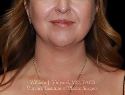 FACEtite Before & After Gallery - Patient 237011 - Image 1