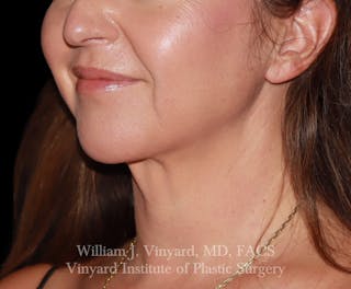 FACEtite Before & After Gallery - Patient 237011 - Image 4