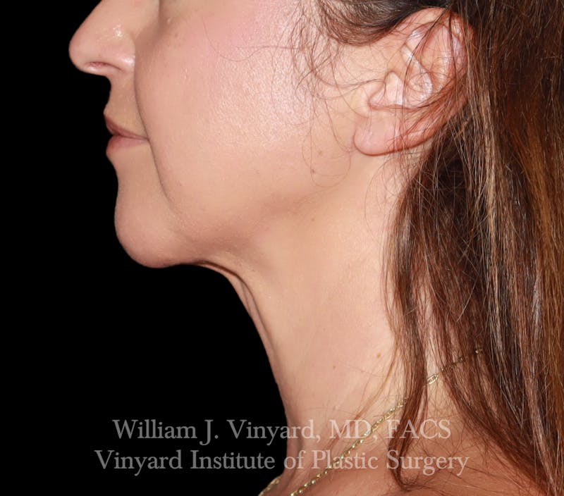 FACEtite Before & After Gallery - Patient 237011 - Image 8