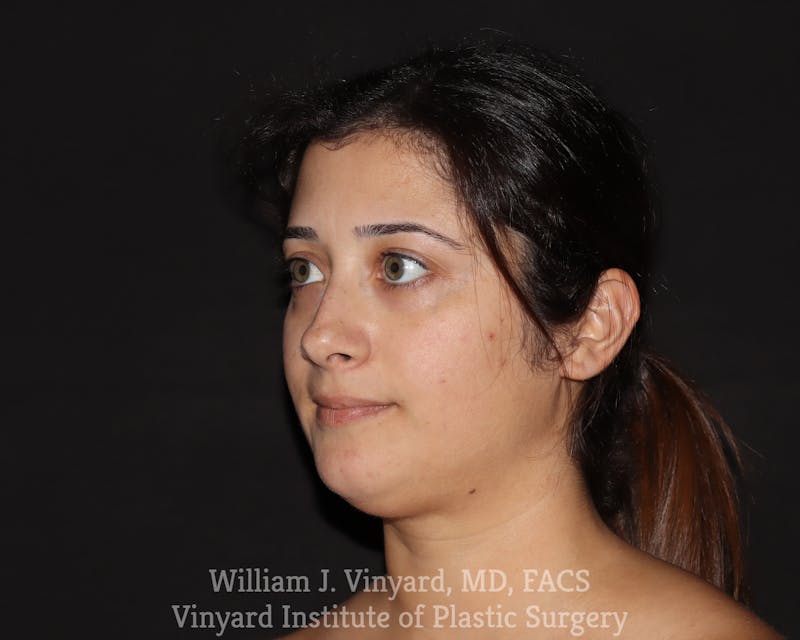 FACEtite Before & After Gallery - Patient 217776 - Image 3