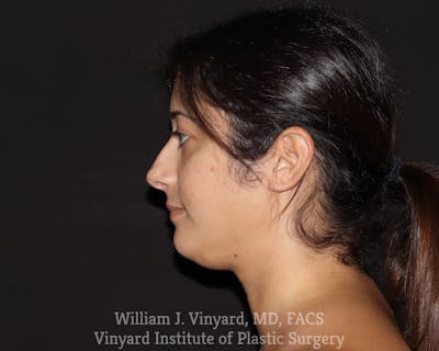 FACEtite Before & After Gallery - Patient 217776 - Image 1