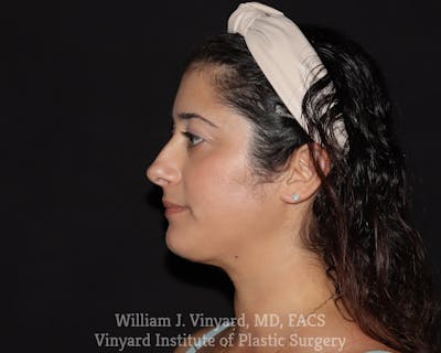 FACEtite Before & After Gallery - Patient 217776 - Image 2