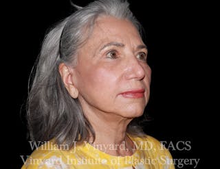 Facelift (Cheek and Neck Lift) Before & After Gallery - Patient 343051 - Image 8