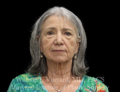 Facelift (Cheek and Neck Lift) Before & After Gallery - Patient 343051 - Image 1