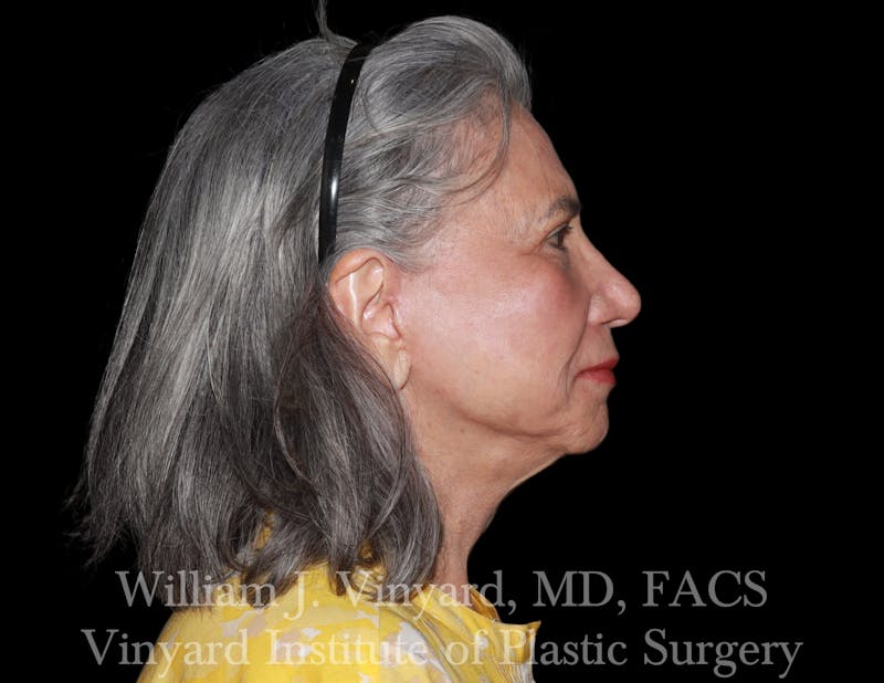 Facelift (Cheek and Neck Lift) Before & After Gallery - Patient 343051 - Image 4