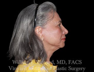 Facelift (Cheek and Neck Lift) Before & After Gallery - Patient 343051 - Image 4