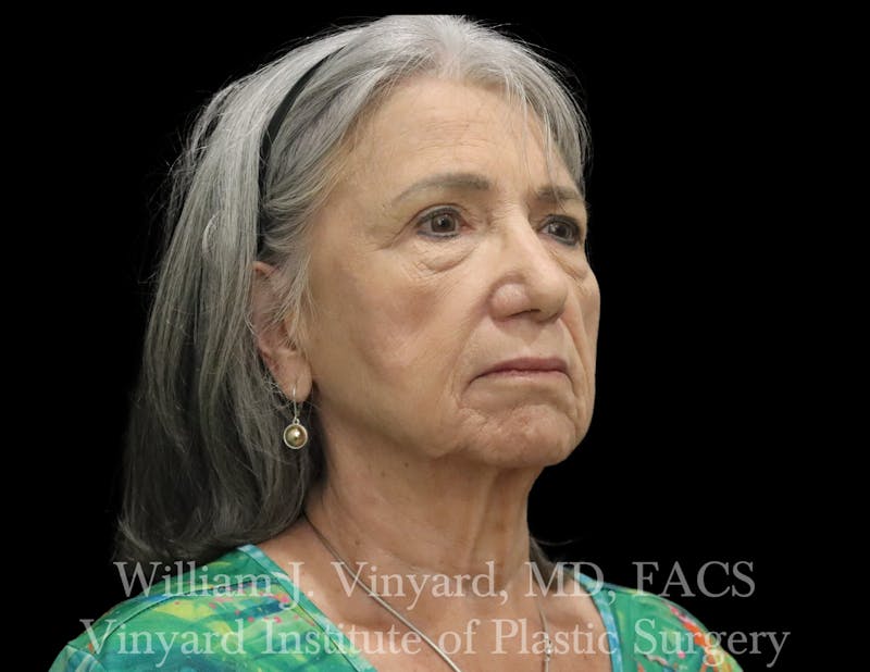 Facelift (Cheek and Neck Lift) Before & After Gallery - Patient 343051 - Image 7