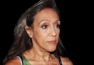 Facelift (Cheek and Neck Lift) Before & After Gallery - Patient 237619 - Image 4