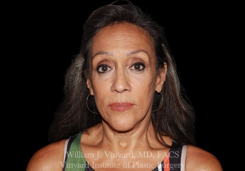 Facelift (Cheek and Neck Lift) Before & After Gallery - Patient 237619 - Image 2