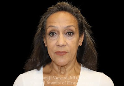 Facelift (Cheek and Neck Lift) Before & After Gallery - Patient 237619 - Image 1