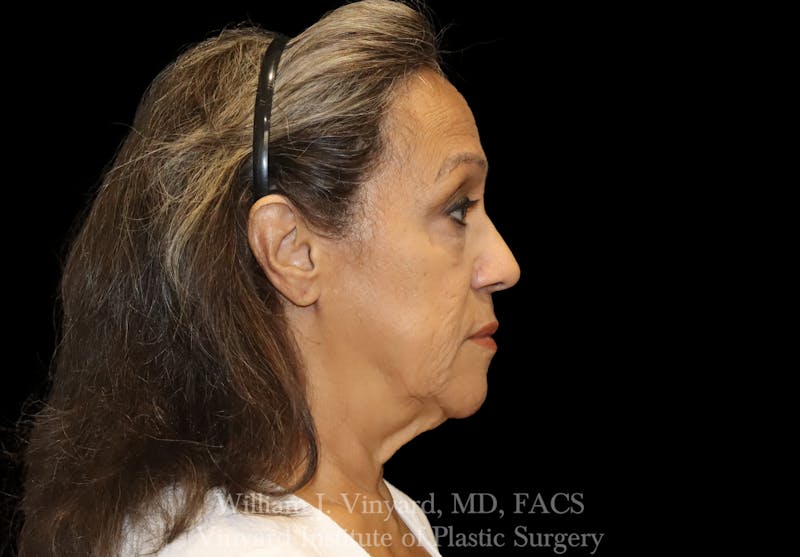 Facelift (Cheek and Neck Lift) Before & After Gallery - Patient 237619 - Image 5