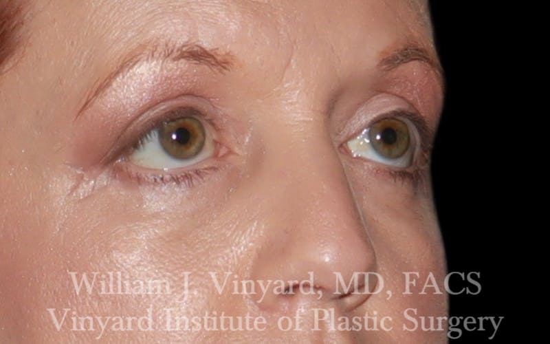 Eyelid Lift Before & After Gallery - Patient 245239 - Image 4