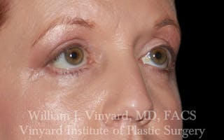 Eyelid Lift Before & After Gallery - Patient 245239 - Image 4