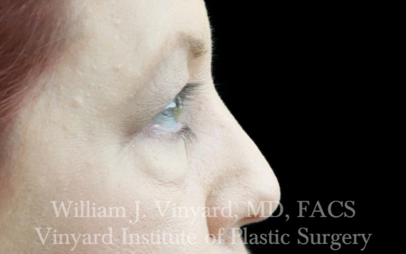 Eyelid Lift Before & After Gallery - Patient 245239 - Image 5