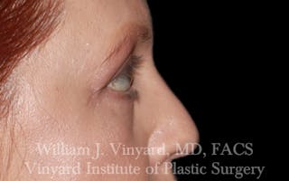 Eyelid Lift Before & After Gallery - Patient 245239 - Image 6